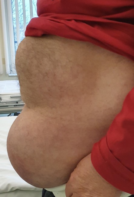 Primary and Incisional (Postoperative) Abdominal Hernias